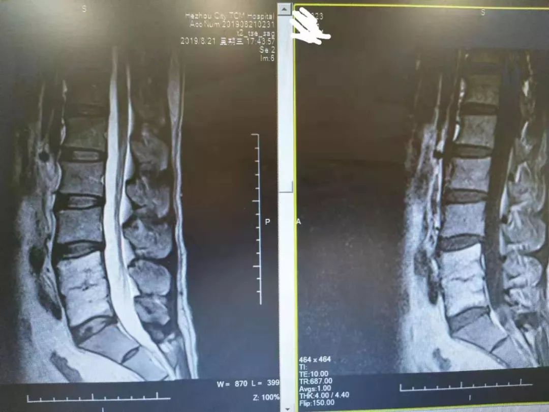 分享两例脊柱结核病例