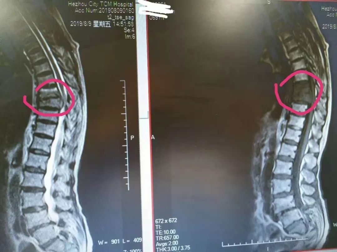 分享两例脊柱结核病例