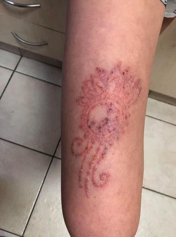 原创11岁澳洲女孩在巴厘岛做了个指甲花纹身遭遇严重感染恐终身留疤