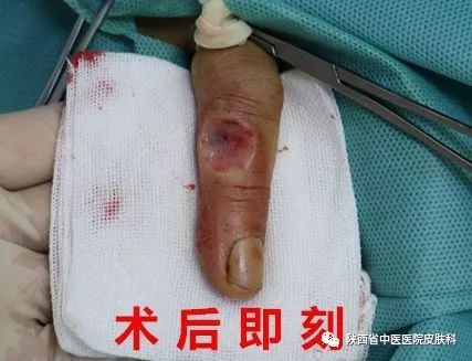 【皮肤外科每周一例】第8例-化脓性肉芽肿手术治疗