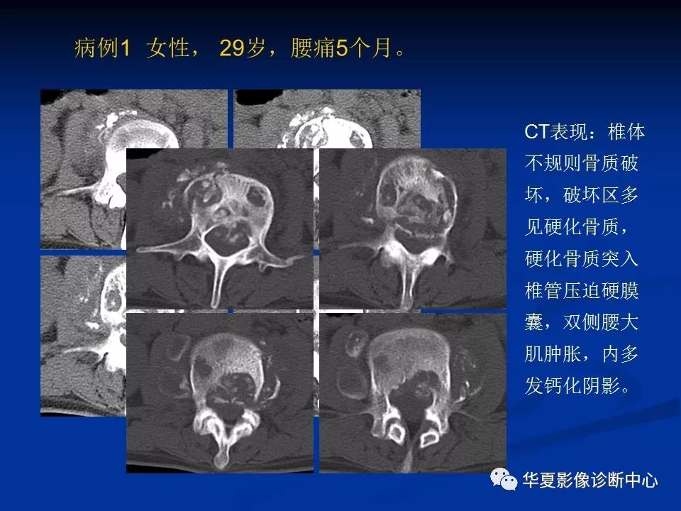 影像重温丨腰椎结核的ct诊断与鉴别诊断