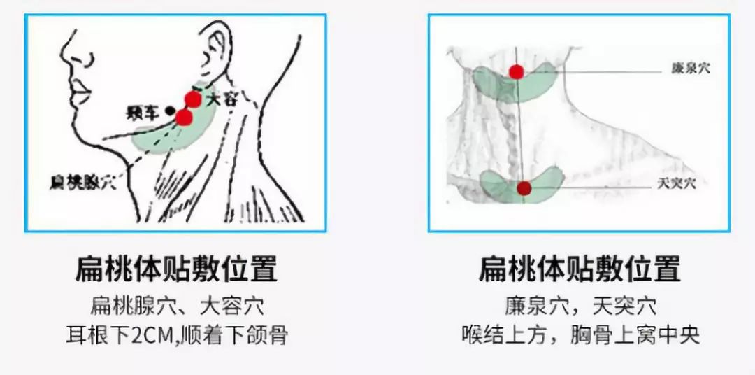 扁桃体艾灸位置示意图图片