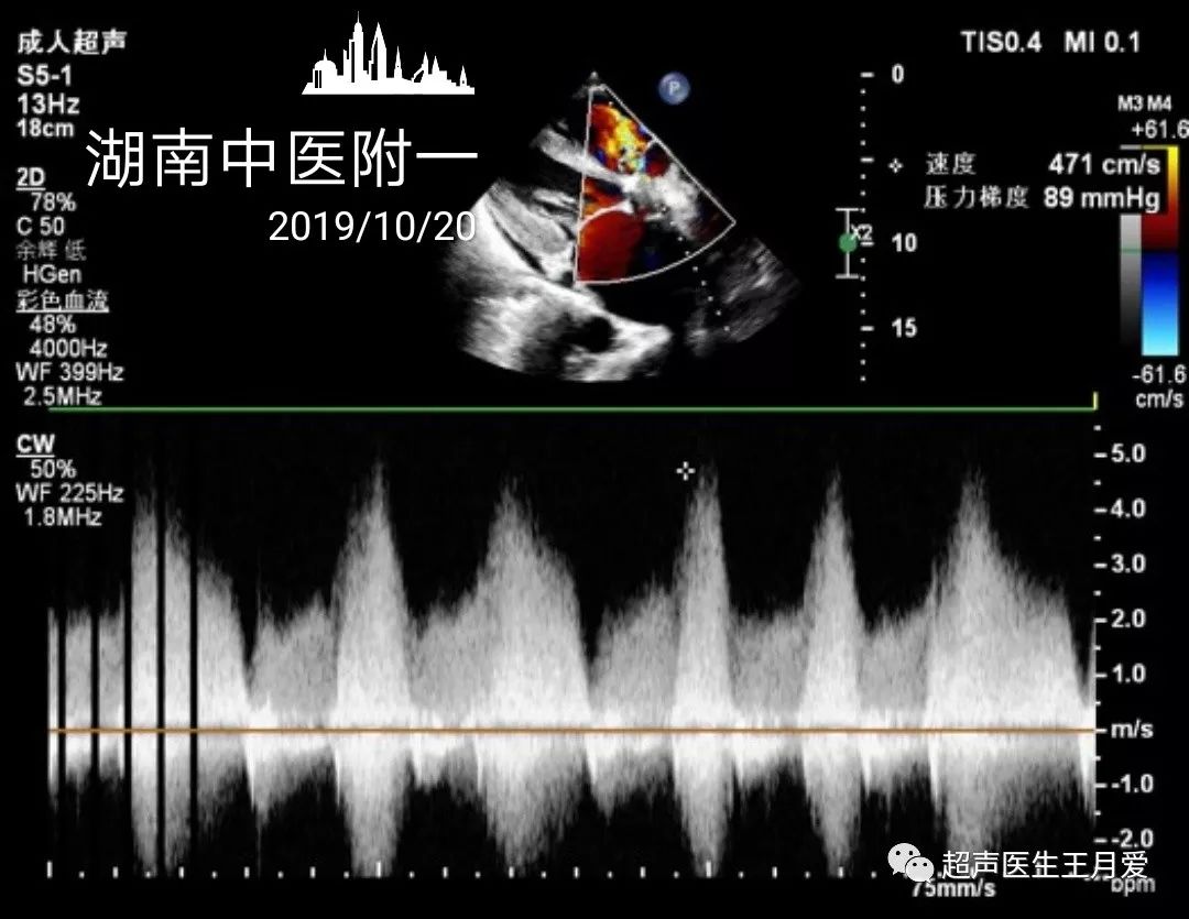 淺談室間隔缺損與主動脈竇瘤破裂