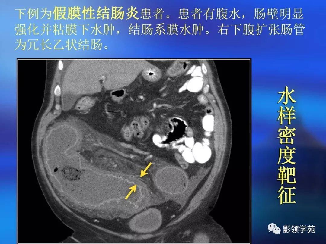 腸道壁增厚ct表現