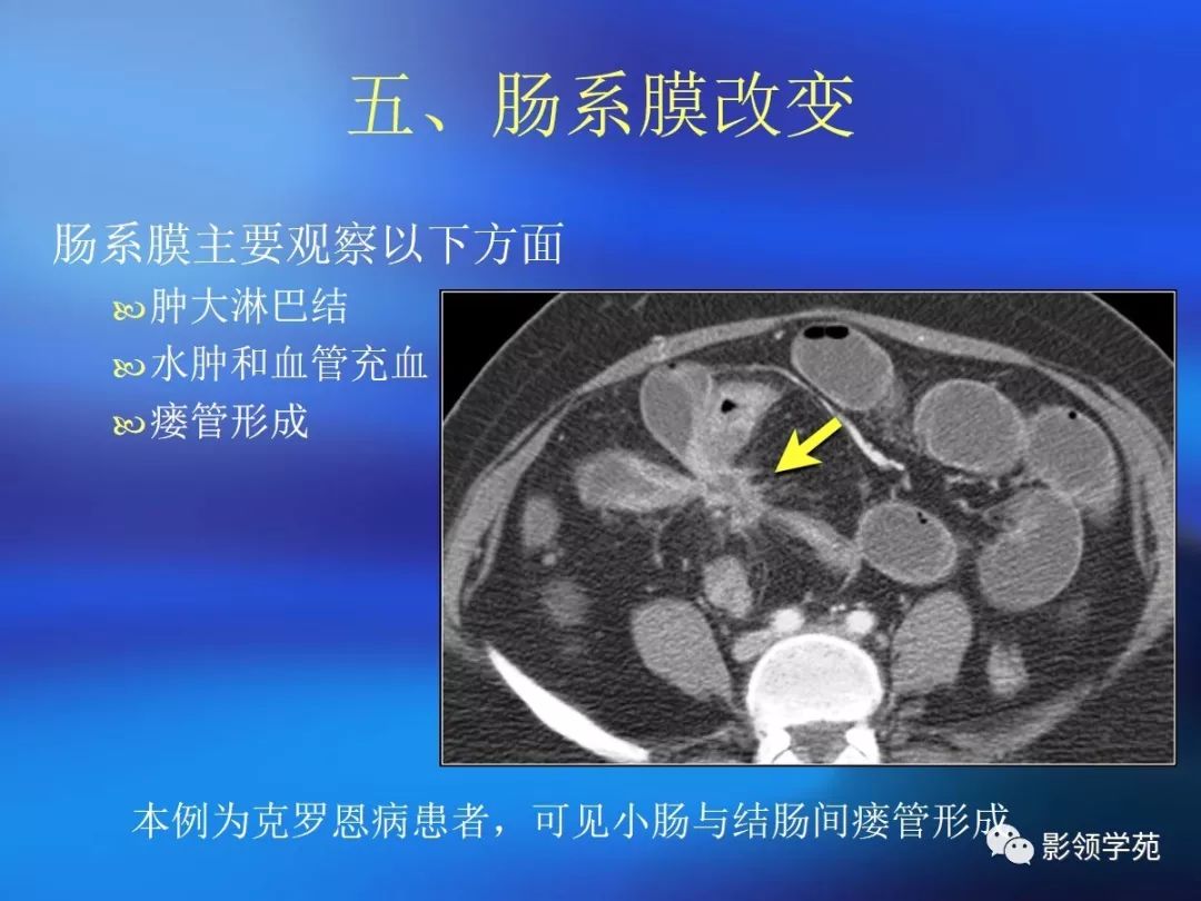 脂肪有时见于乳糜泻ct 评价肠壁增厚存在的问题肠道是蠕动的空腔器官