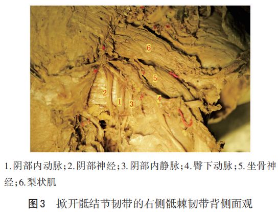 骶棘韌帶區域解剖和三維重建研究