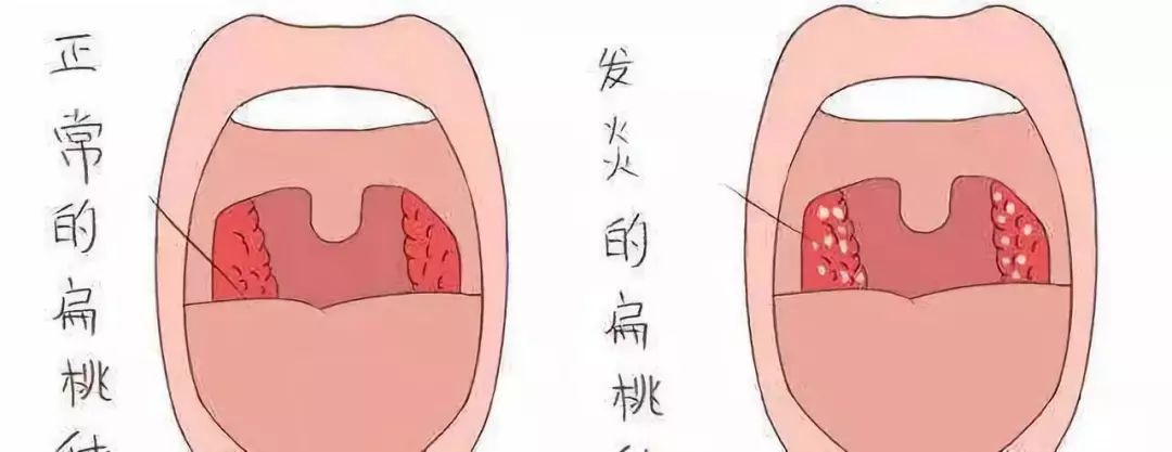 扁桃体乳头状瘤 来自搜狐网