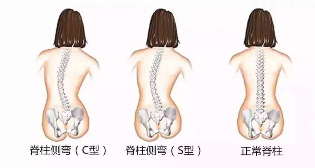 穩定性,預防和治療脊柱側彎疼痛綜合症,提高運動功能和改善體態美學