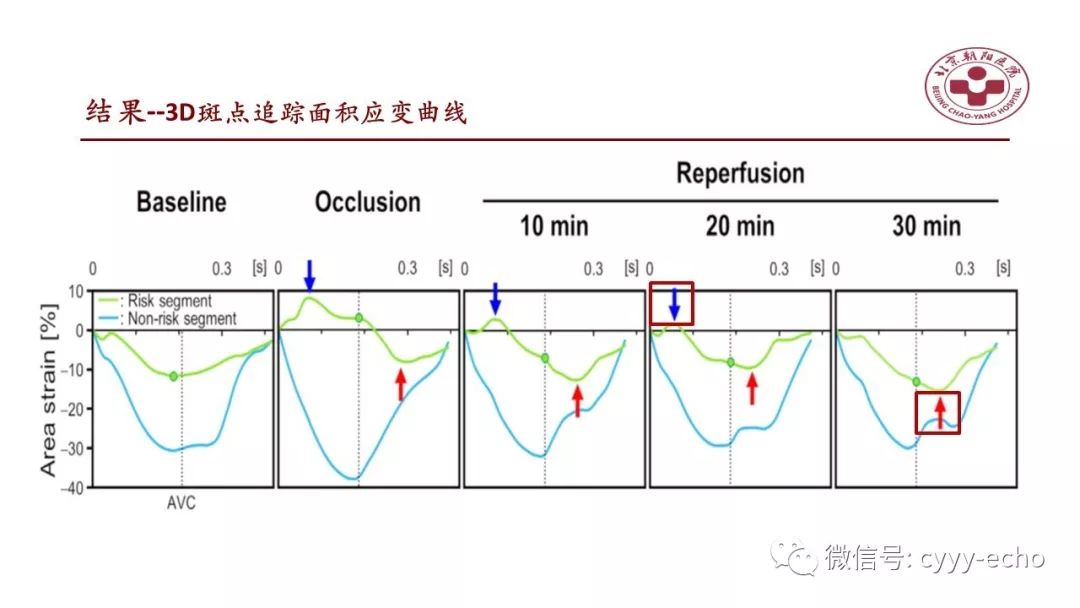 斑点追踪超声心动图检测,sl和pss综合分析可提高既往缺血诊断的准确性