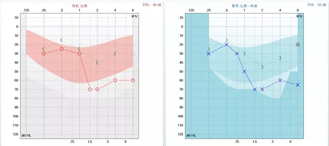听力损失轻佩戴助听器一定会存在堵耳效应吗