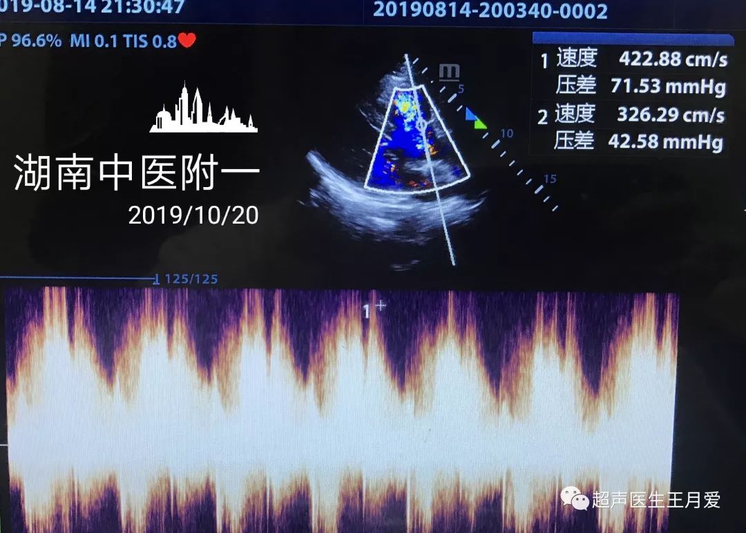 浅谈室间隔缺损与主动脉窦瘤破裂