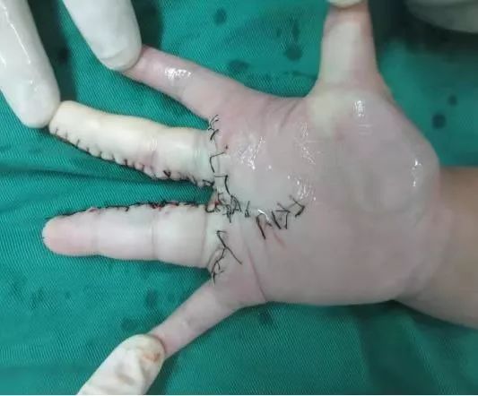 小男孩患巨指症,医生巧施减容术让巨指"瘦身"_治疗