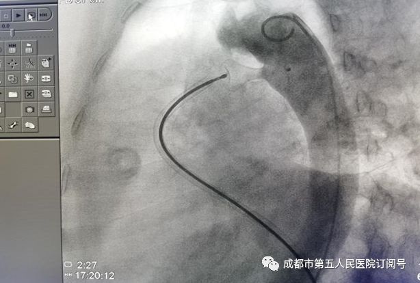 市五医院为内脏反位患者成功开展动脉导管未闭封堵术