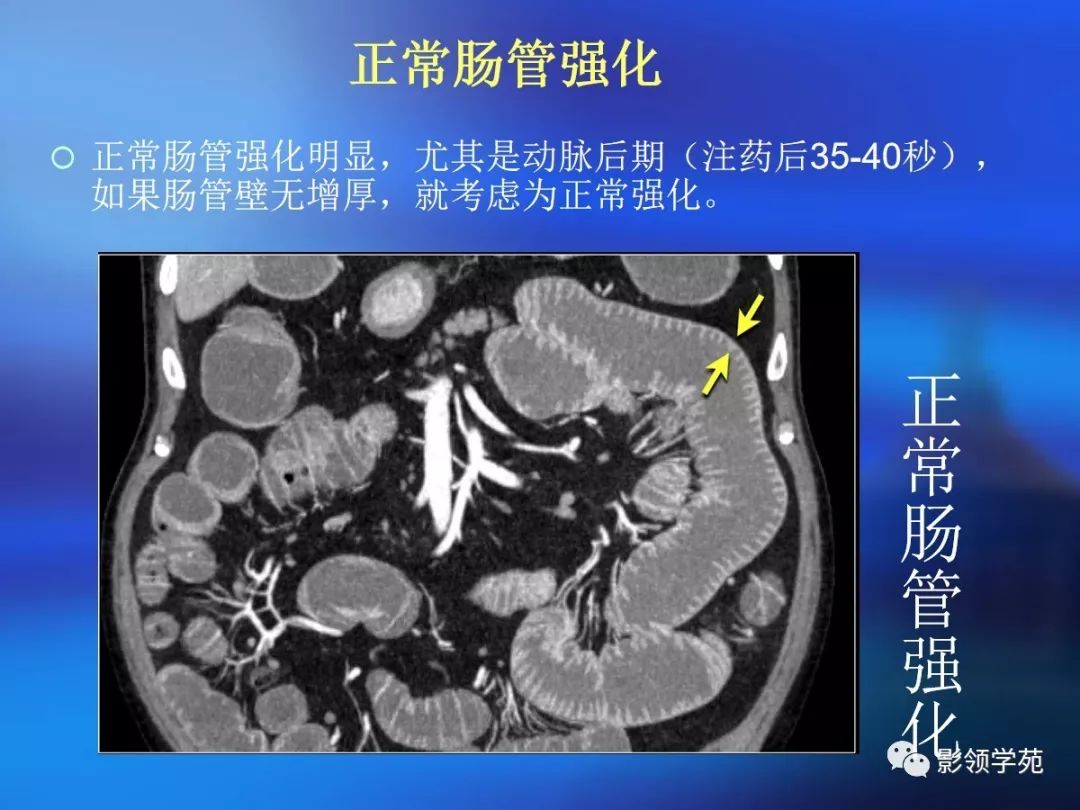 提示長時間梗阻腸腔內血液提示胃腸出血結腸腔內脂肪有時見於乳糜瀉ct