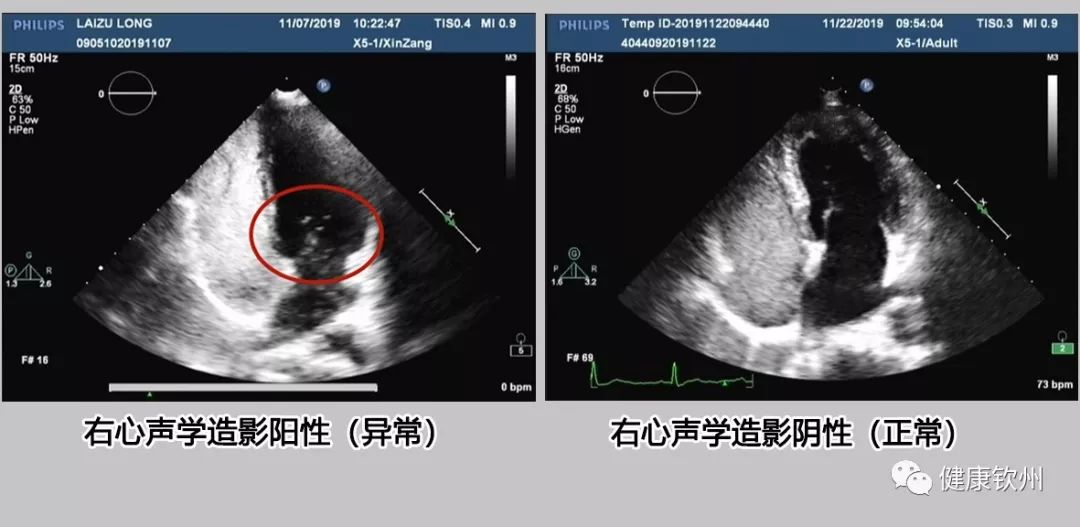 医学圈丨钦州开展首例右心声学造影为少年患者解决大问题