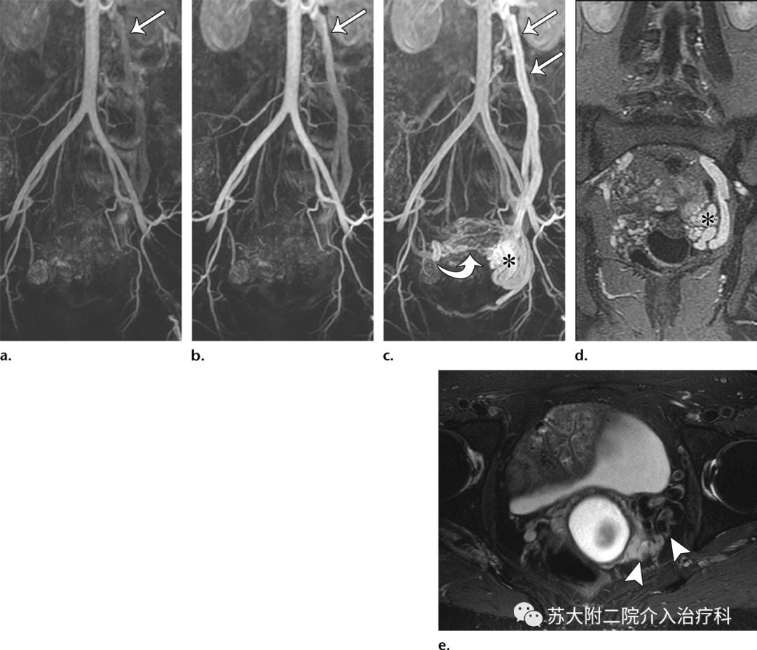 文献速递第294期盆腔淤血综合征影像学表现及非外科手术治疗3