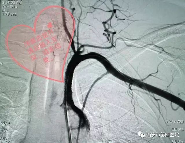 【患者福音】市第四医院心血管介入团队成功实施首例锁骨下动脉闭塞
