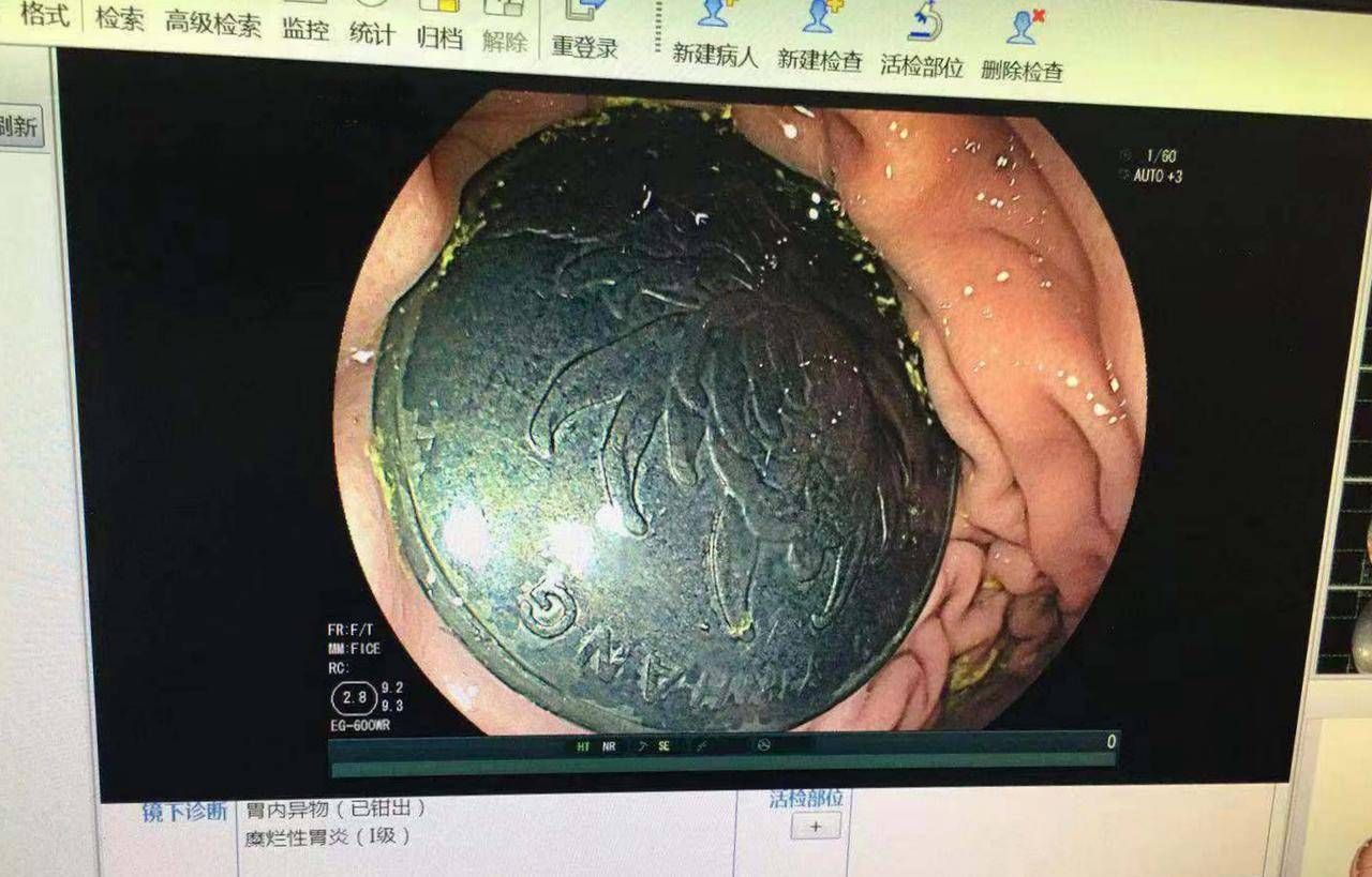 原创六岁男童误吞一元硬币 卡在胃里八天后取出