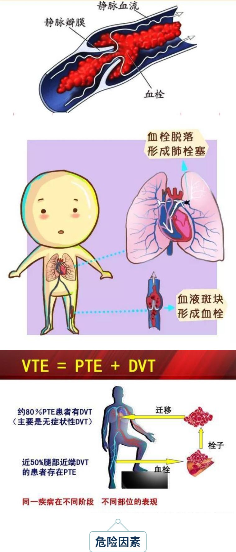 静脉血栓图片卡通图图片