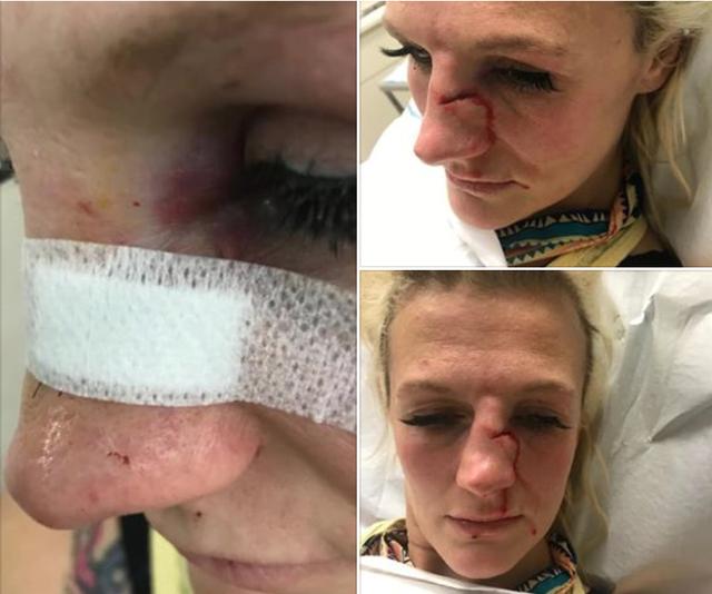 原创前ufc猛女遭男友家暴,鼻子骨折缝7针,坦言若不练拳会被打得更惨