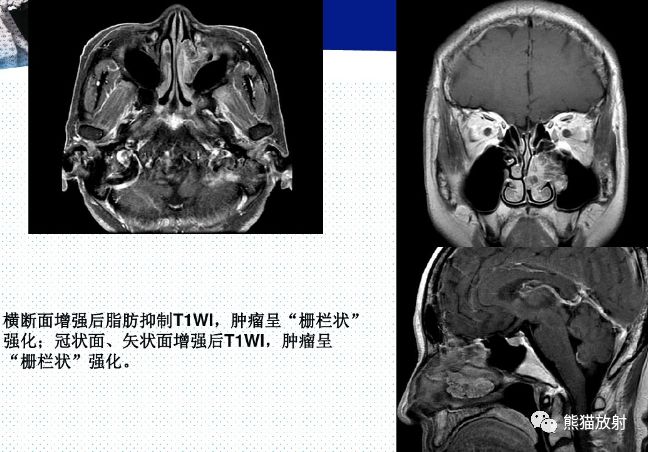 上颌窦病变之内翻性乳头状瘤丨小打卡读片精选29