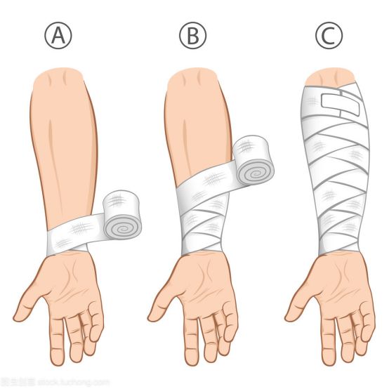 用绷带进行螺旋式加压包扎,检查循环并给予人文关怀.