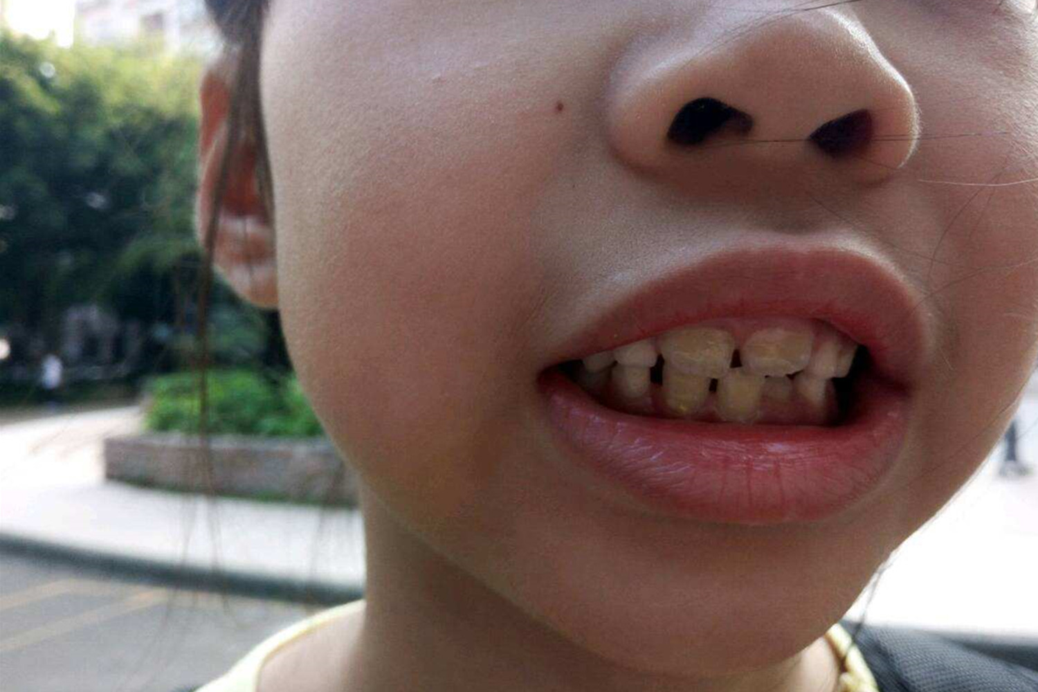7岁孩子长出双排牙,需一颗颗拔掉,只因奶奶的错误喂养方式