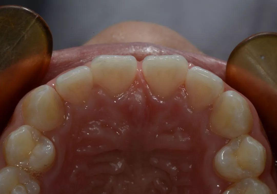 松风病例秀中切牙间隙微创美学修复1例