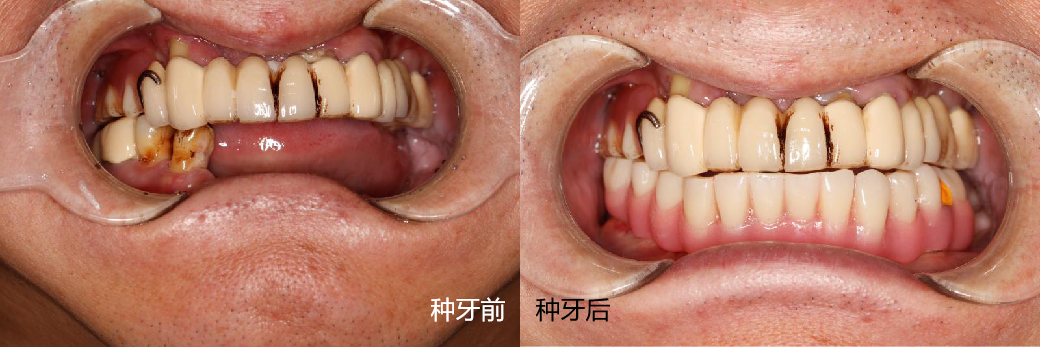 你需要种牙吗你需要半口种牙吗