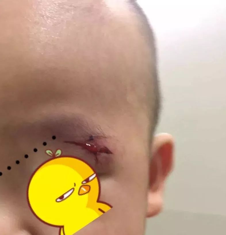 孩子眼睛受伤的图片图片