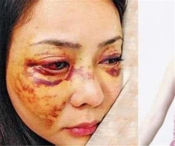 赵敏扮演者婚后遭丈夫家暴脸上都被打肿至今未婚