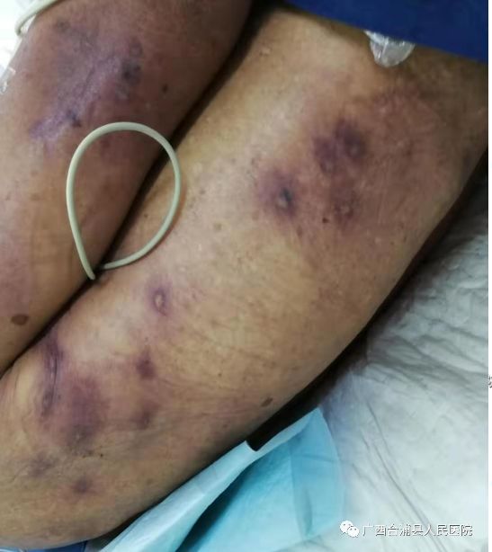 毒蜂伤人不可大意合浦八旬老太被马蜂蜇后命悬一线