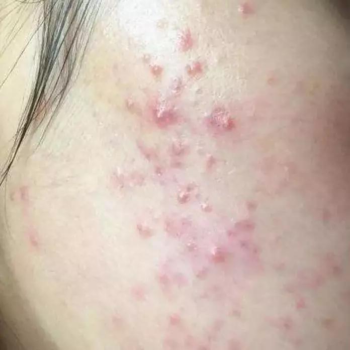 熬夜爆痘烂脸还好我有这个小玛肌肤急救水