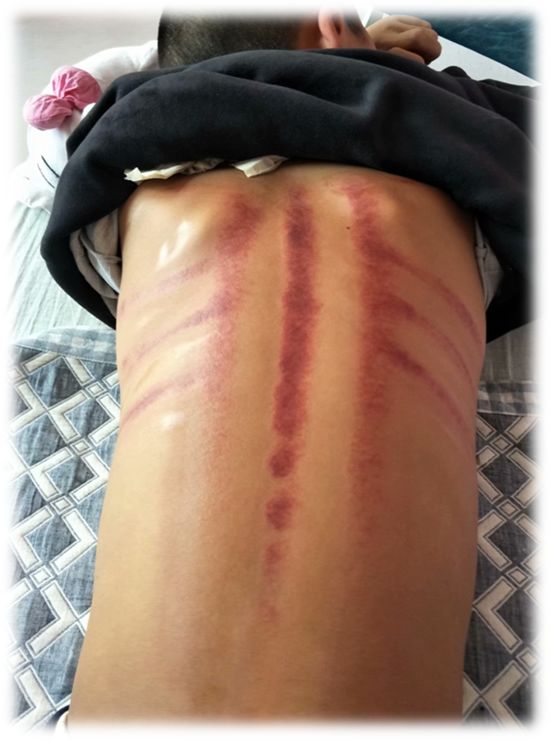 育儿| 对付过敏性咳嗽,儿医亲授这几套中医绿色疗法,收好不谢(内附