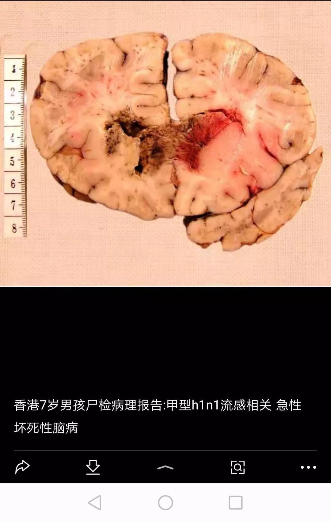 上蔡协和医院 | 警惕急性坏死性脑病