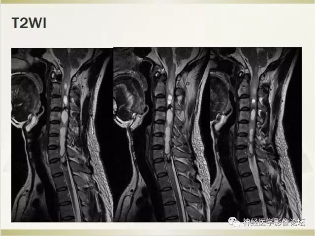 病例学习颈部脊髓细胞型室管膜瘤