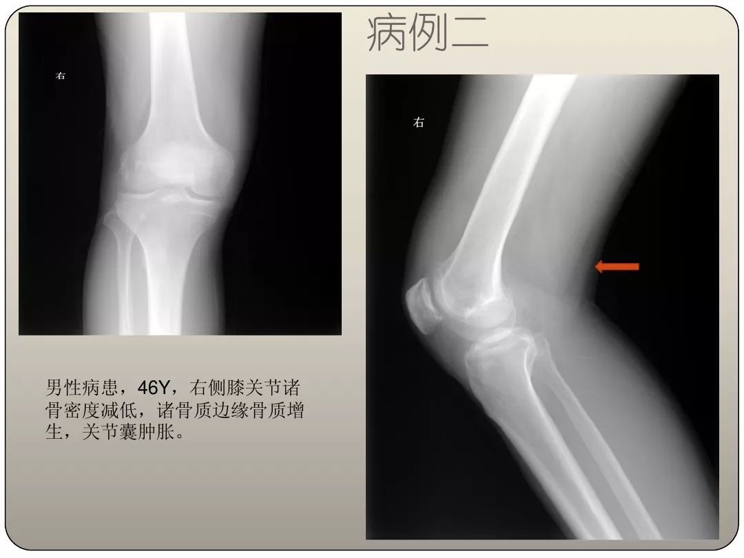 膝关节痛风的影像学诊断