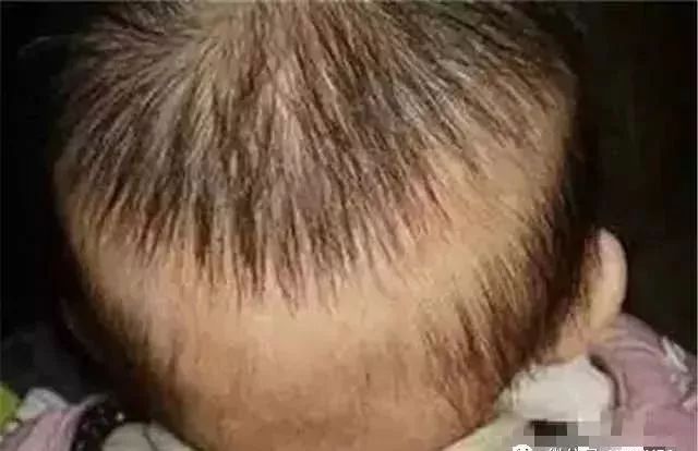 大脑缺钙:神经不稳定,多梦,易醒,磨牙;孩子易惊,后脑勺出汗,咬嘴唇,易