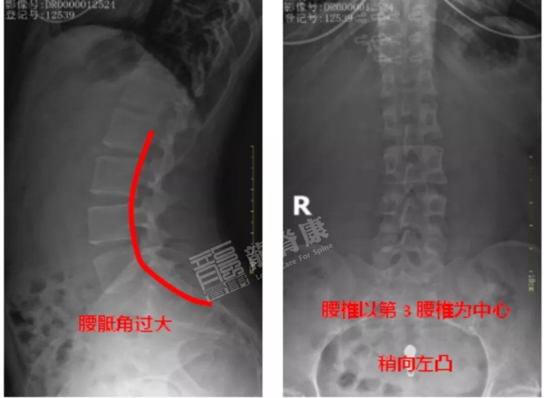 腰椎多棘突偏歪,以第3腰椎为中心稍向左侧凸,腰骶角过大;双侧髂骨左窄