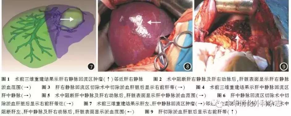 人工智能助力癌症治疗南京鼓楼医院最新肝癌临床治疗学术论文发表