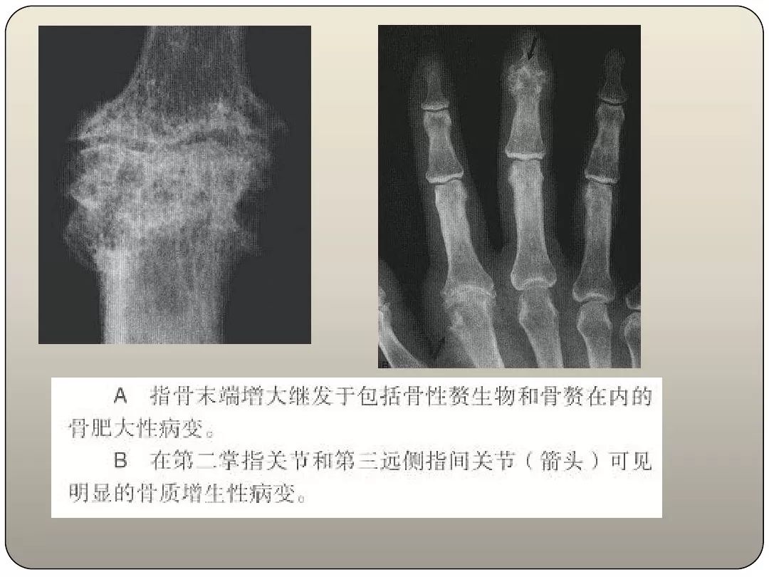 膝关节痛风的影像学诊断