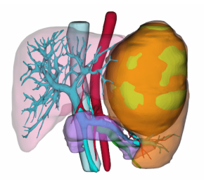 福医二院肝胆胰外科引进edda科技人工智能