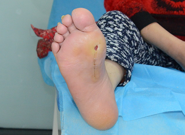 糖尿病患者足部溃烂伤口久不愈合怎么办可以不截肢吗