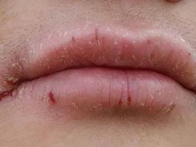 拯救嘴唇起皮干裂要这样做