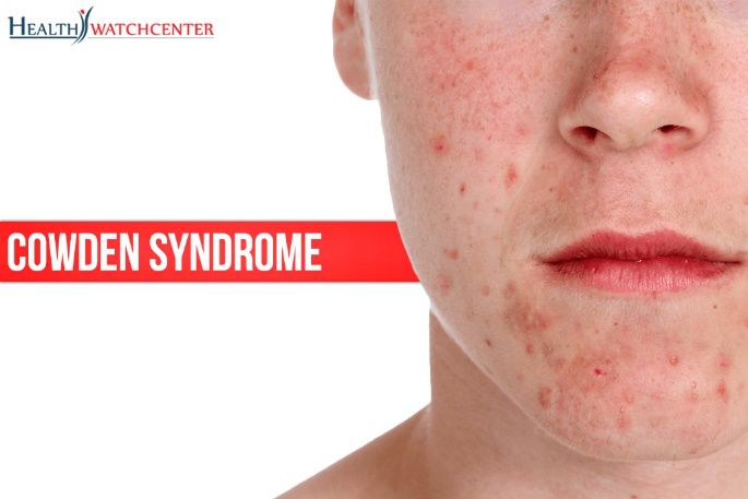 考登综合征(cowden syndrome)又叫做多发错构瘤综合征,特点是面部淡