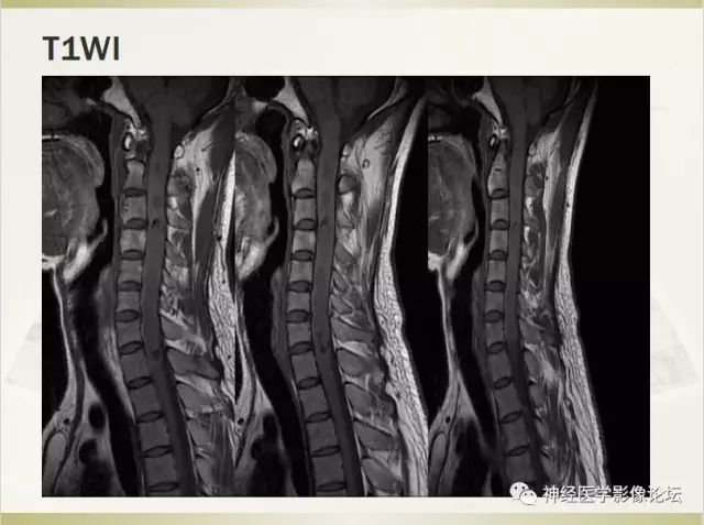 病例学习颈部脊髓细胞型室管膜瘤
