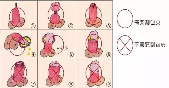 翻包茎的正确做法图片