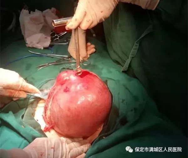 子宫肌瘤是女性生殖器官最常见的良性肿瘤,其发生可能与女性激素有关