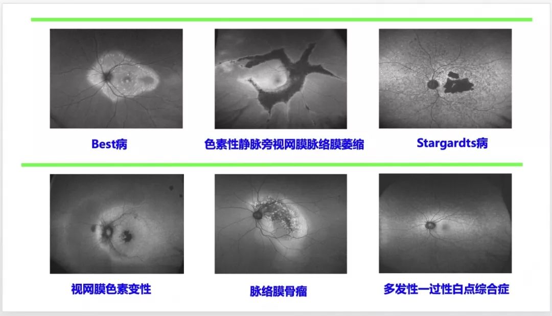 自发荧光对视网膜变性类/遗传性视网膜疾病,如:rp,stargardt病,best病