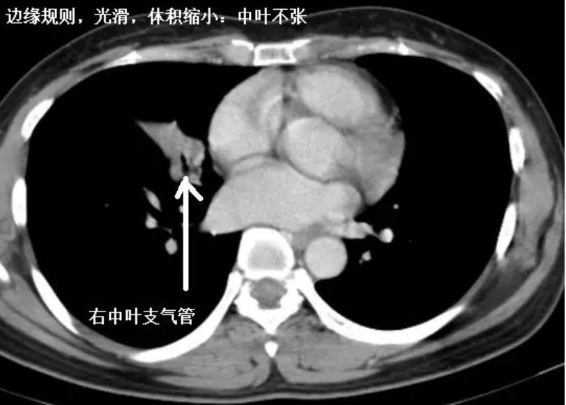 就是肺缩小,患者的肺很膨胀,可排除.3.